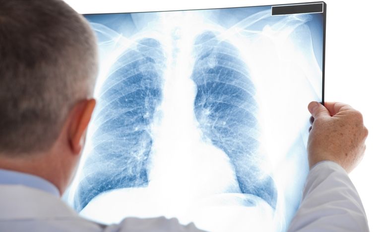 Estos son los síntomas del cáncer de pulmón: hazles caso