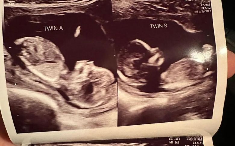Una mujer que nació con dos úteros está embarazada en ambos
