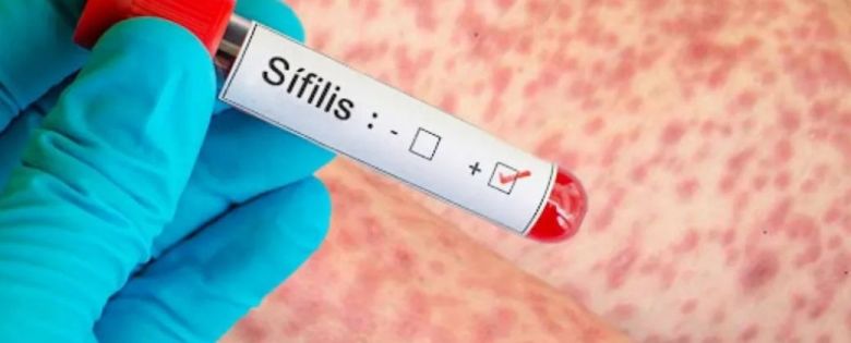 Preocupante aumento de casos de sífilis: "Mientras más se busca, más se encuentra"
