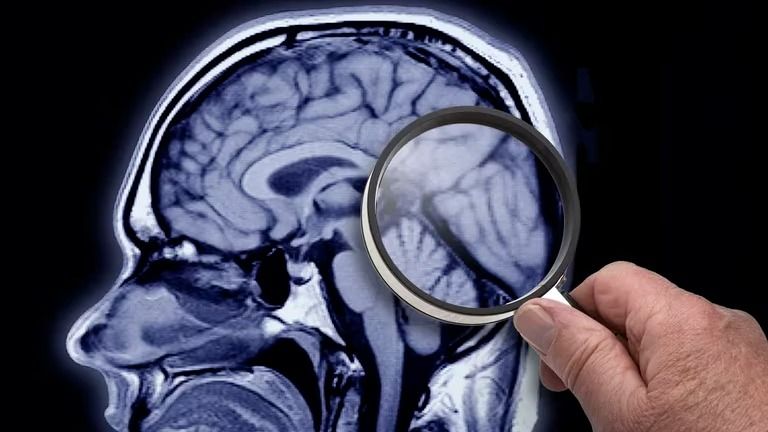 Alzheimer: estudian si un joven de 19 años es el caso más temprano de la enfermedad